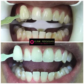 Dr Feeliz whitening treatment photograph